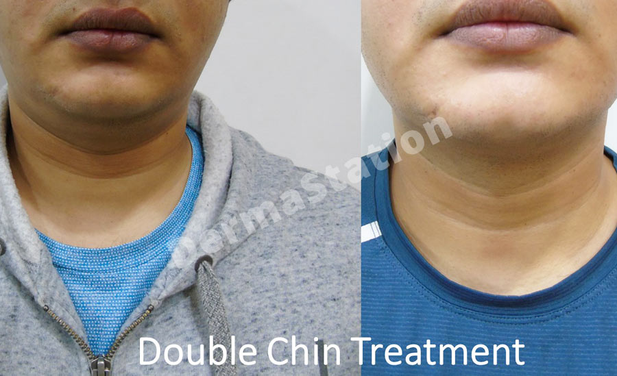 Double Chin Treatment In Delhi